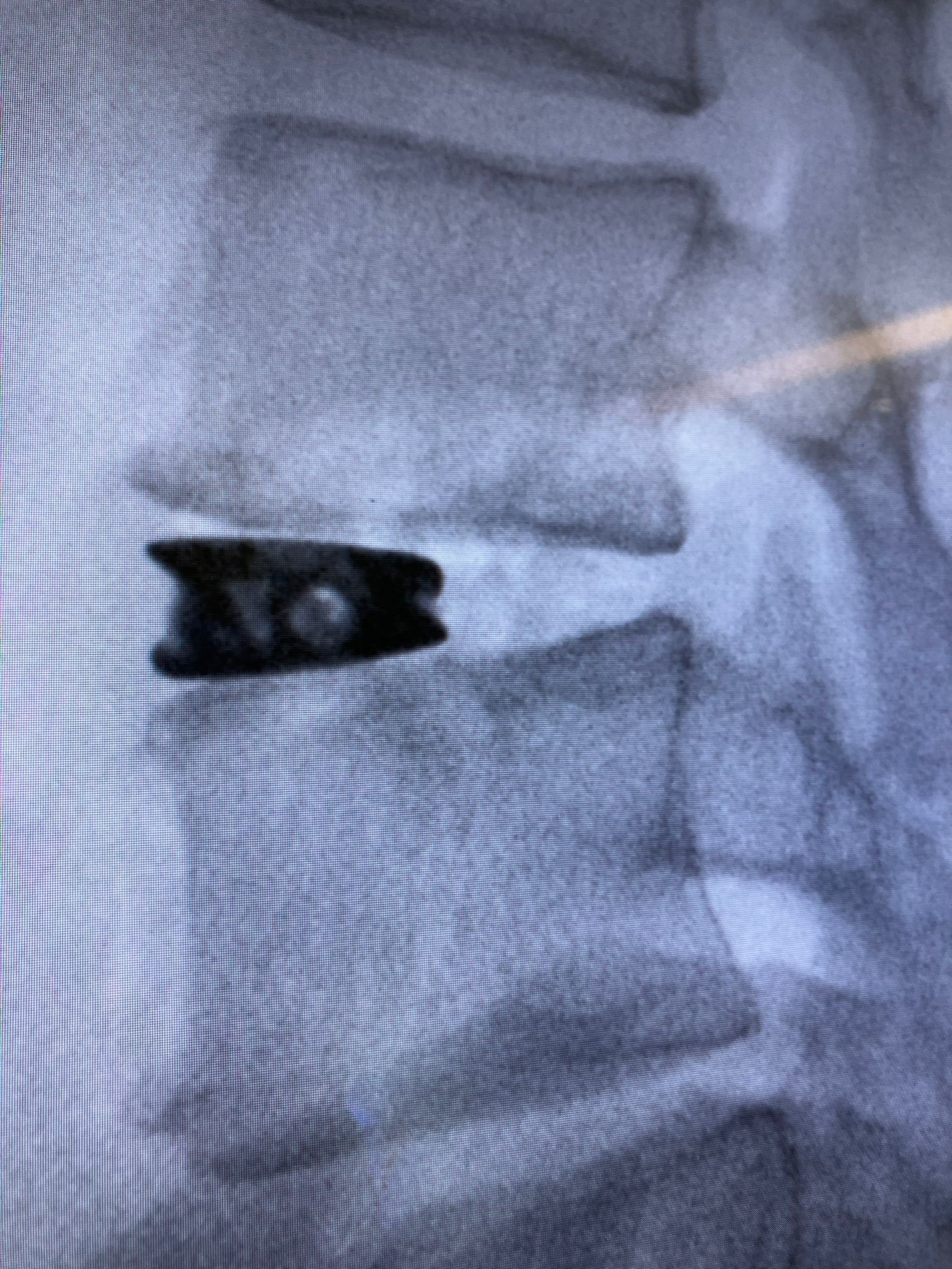 técnica XLIF