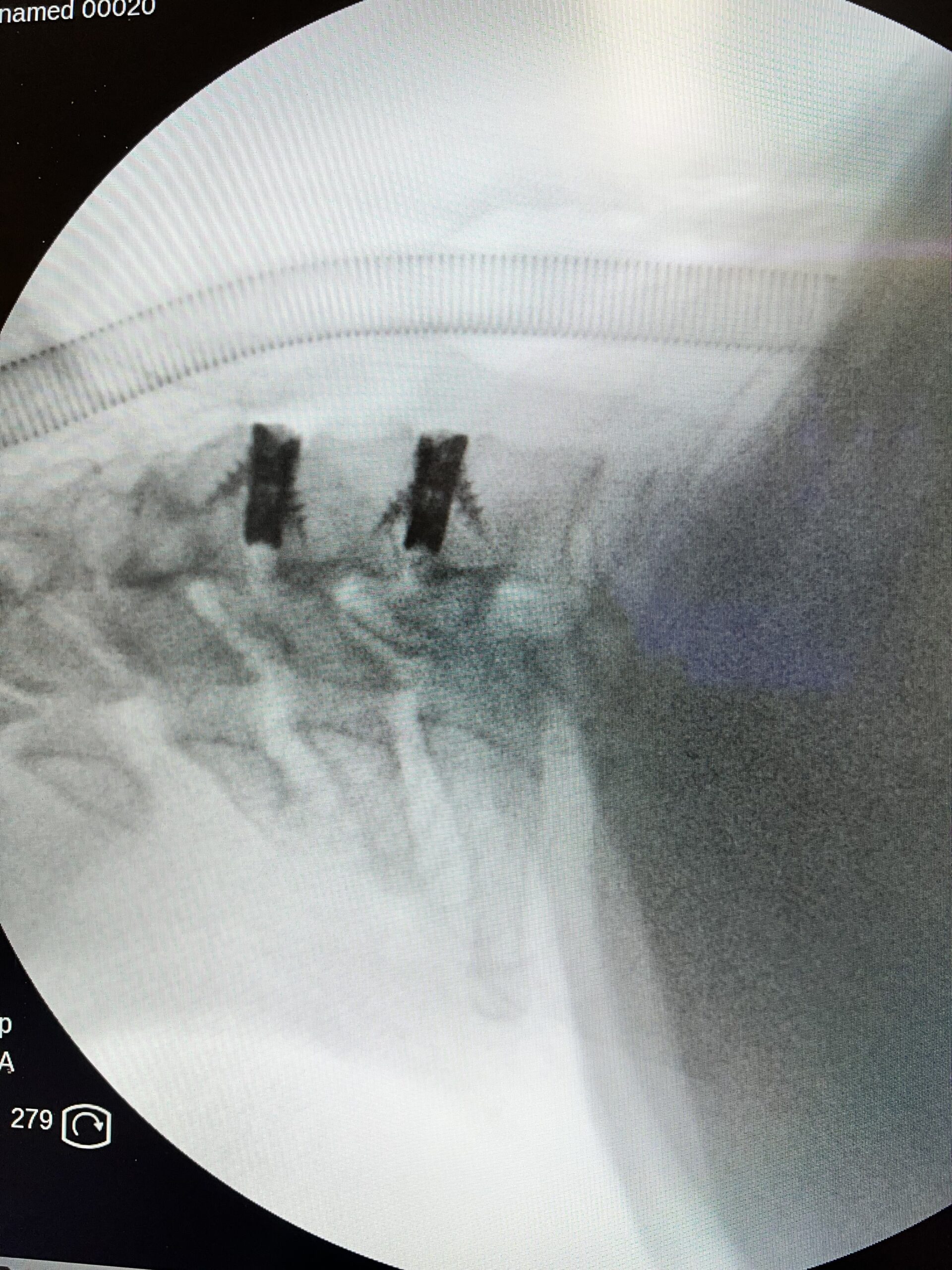 Hernia discal cervical