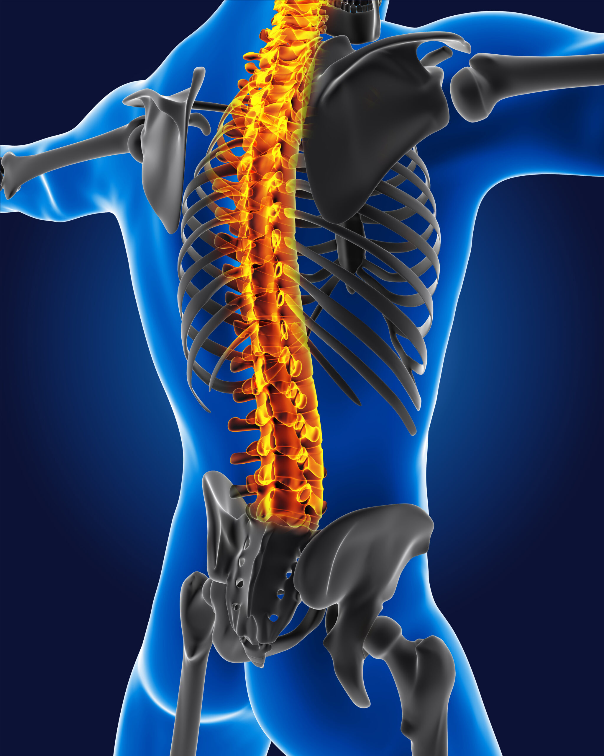 Ilustración de la artrosis facetaria lumbar en la columna vertebral